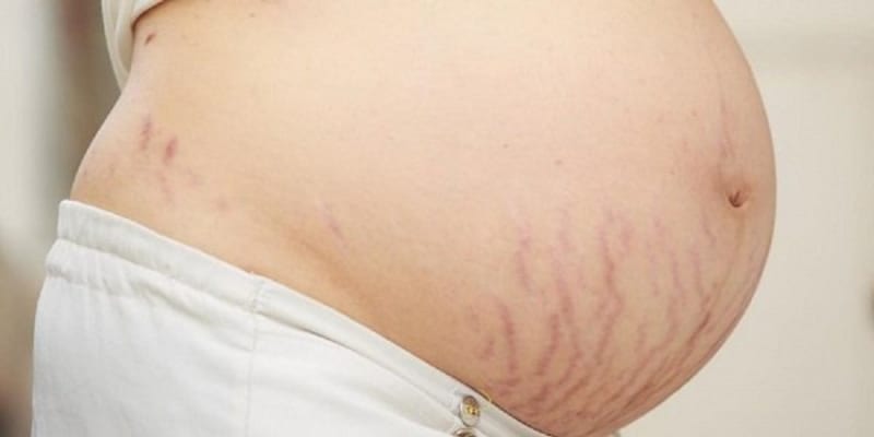 Top 5+ cách chữa rạn da sau sinh tại nhà mẹ bầu nên biết 8