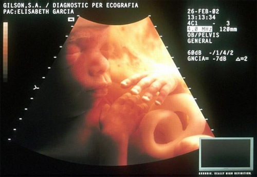 Phương pháp siêu âm xác định giới tinh thai nhi chuẩn nhất hiện nay