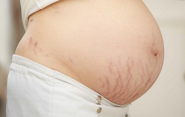 4 cách trị rạn nứt da bụng sau khi sinh không cần đi viện thẩm mỹ 1